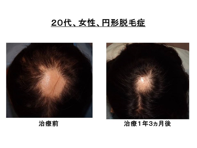 ”円形脱毛症　病院"